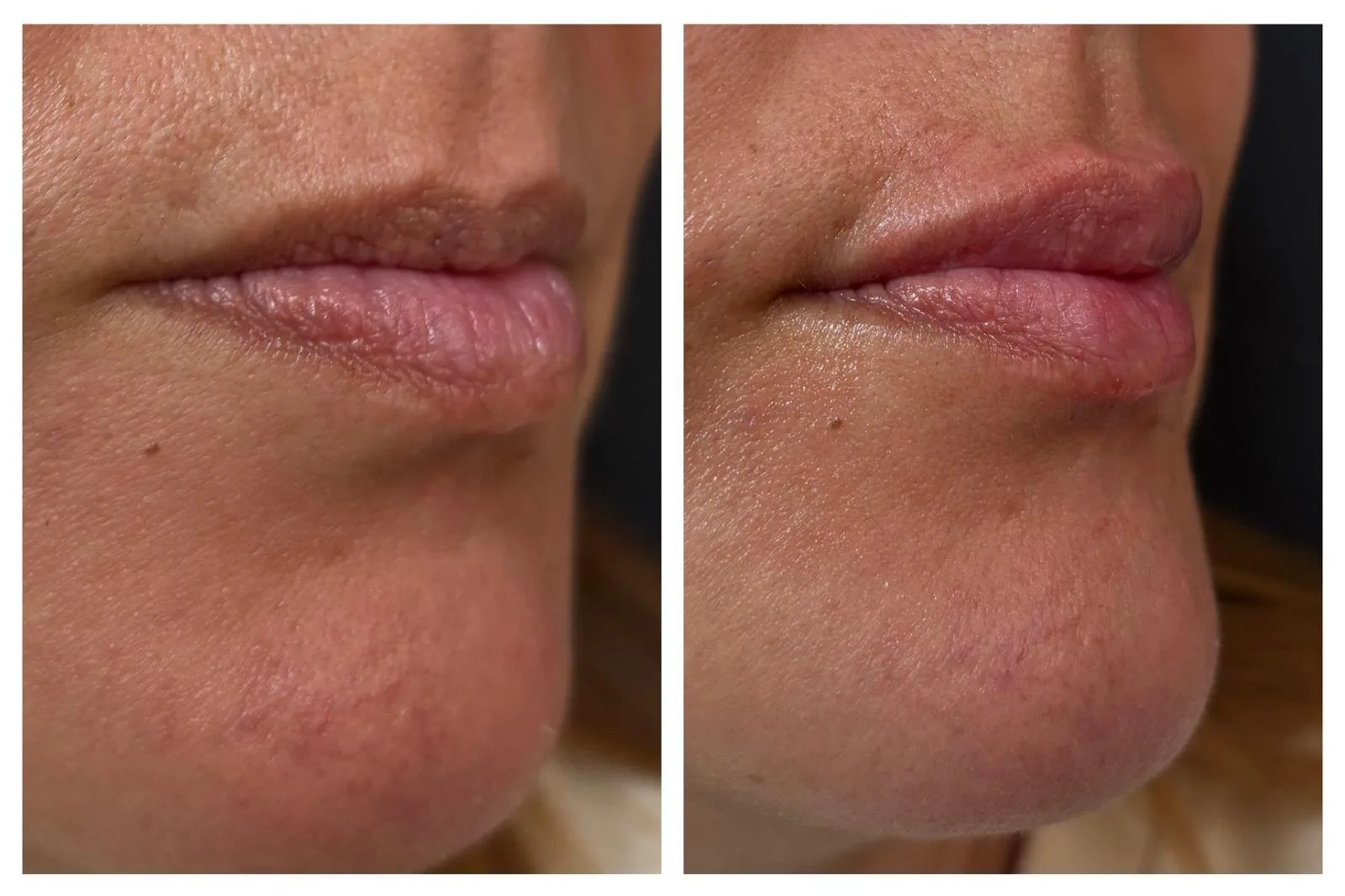 Relleno de Labios en Madrid - Tratamiento realizado por la Dra. Ava Ardila